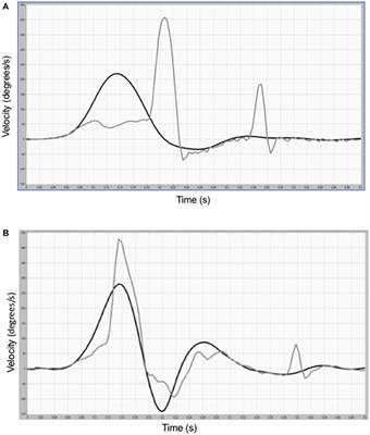 Functional Head Impulse Testing Might Be Useful for Assessing Vestibular Compensation After Unilateral Vestibular Loss